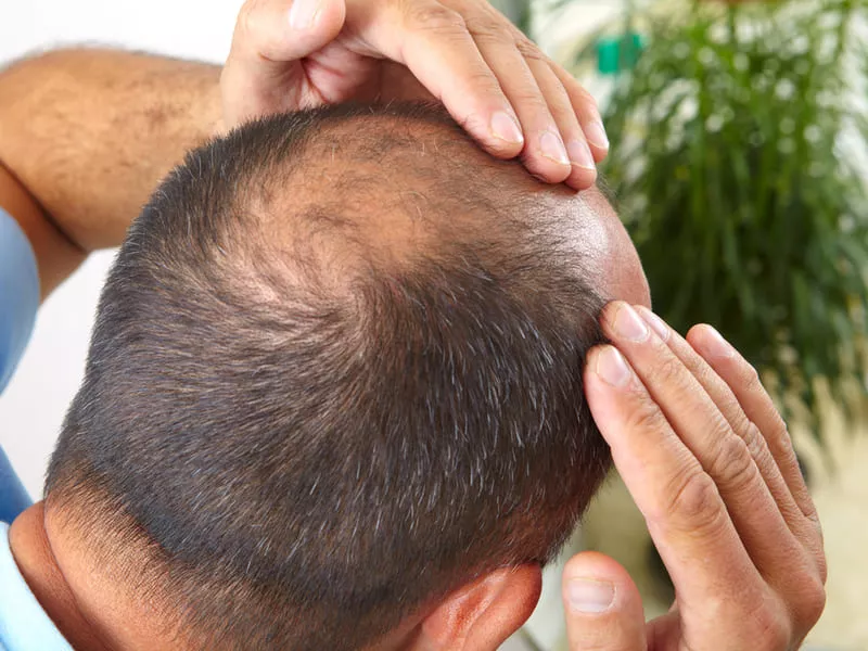 Treatment And Remedy Suggestions To Prevent Hair Loss | Bioxsine