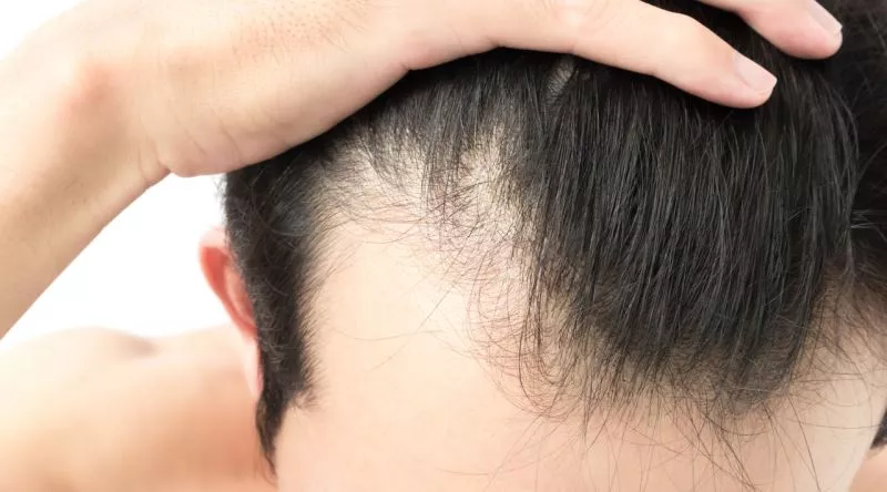 Is Hair Loss Hereditary?