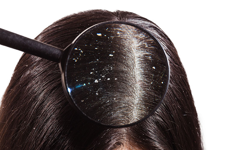 Things You Should Pay Attention to While Buying Dandruff Shampoos