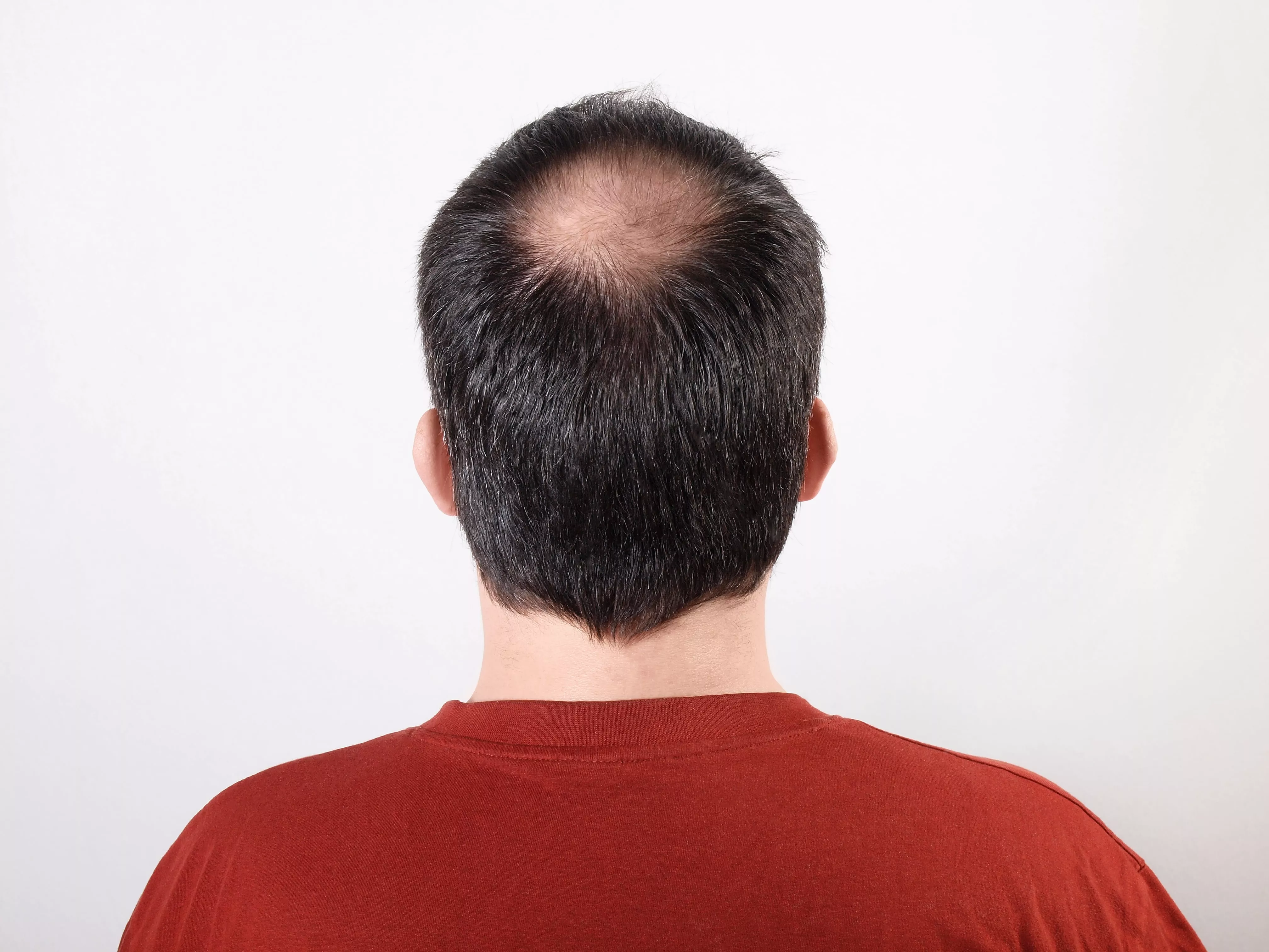 Everything You Need to Know about Hair Transplantation