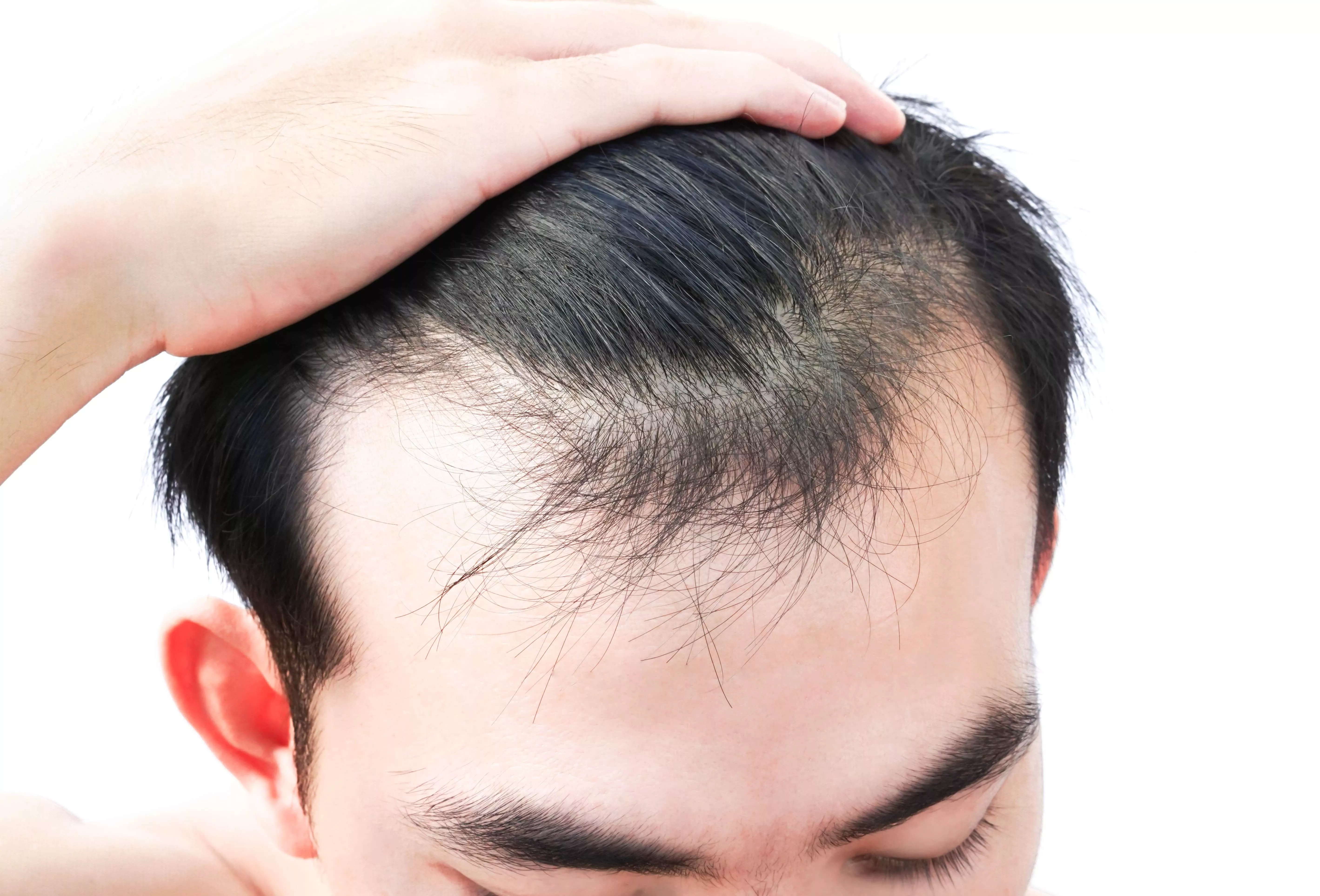 Does Hair Fall Out After Hair Transplant