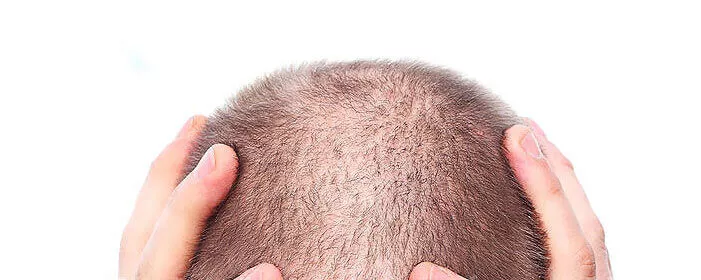 What Are the Types of Hair Loss?