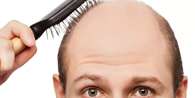 What are the Types of Hair Loss?