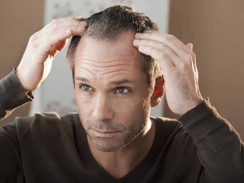 Hair Loss and How to Prevent It